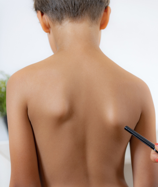 척추측만증 이미지