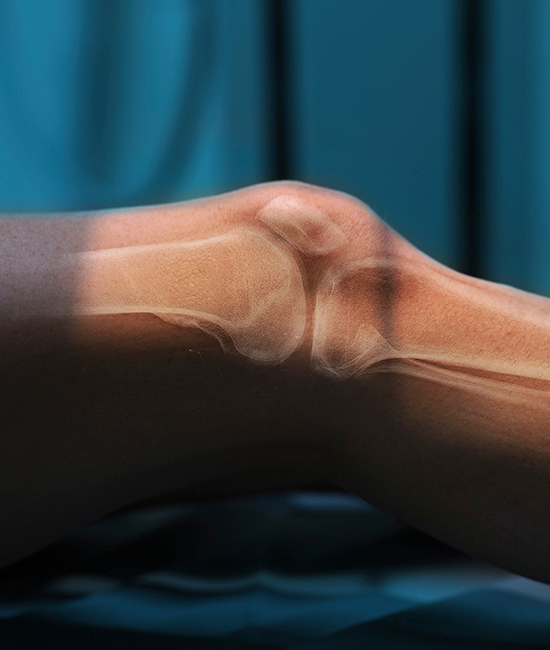 반월상 연골판 손상